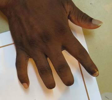The tips of Elayaraja's index, middle and ring fingers were severed
